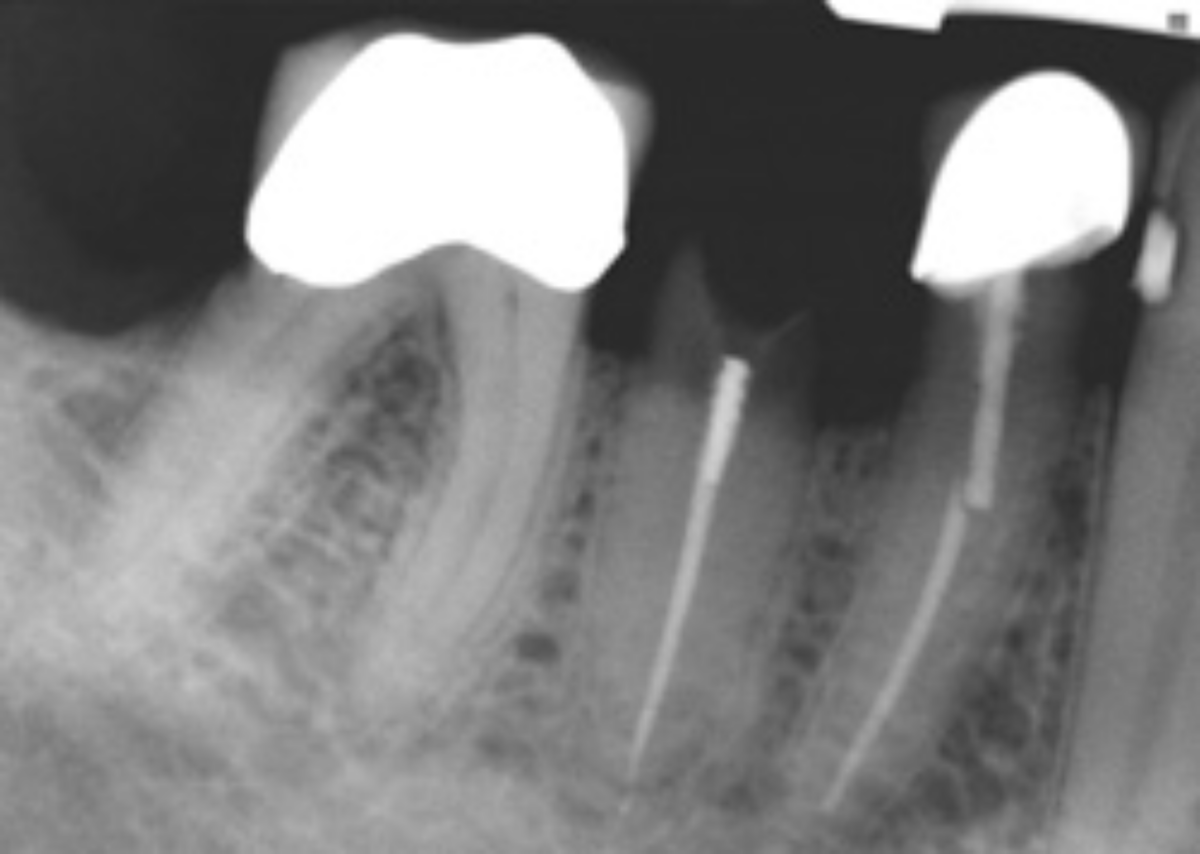Post & Core Restoration Jensen Endodontics Inc