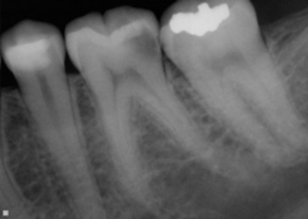 Root Canal Therapy Jensen Endodontics Inc